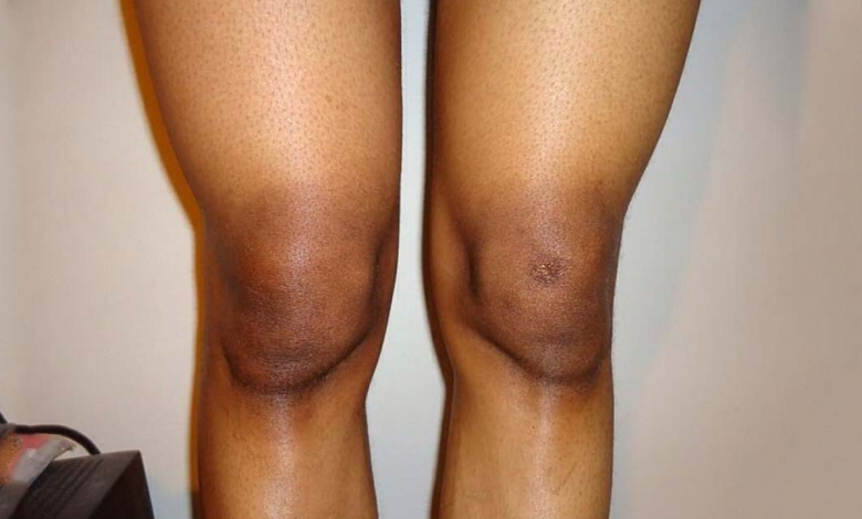 Natural Ingredients That Help Lighten Dark Knees Achieve smooth and Pink toned knees Not always require expensive treatments or bad chemicals. Natural ingredients know for their skin brightening items can work wonders in lightening dark knees effectively.